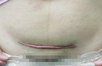 剖腹产后的疤痕要怎么淡化和消除